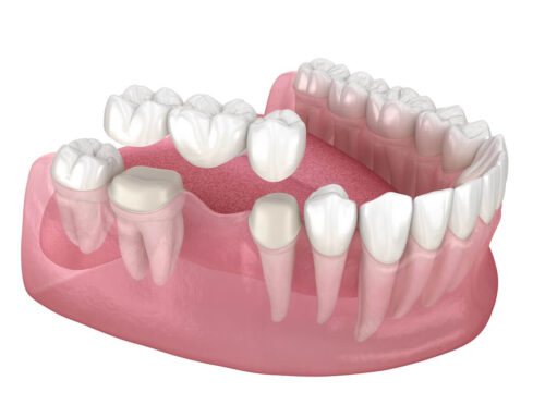 When Do You Need Dental Bridges?